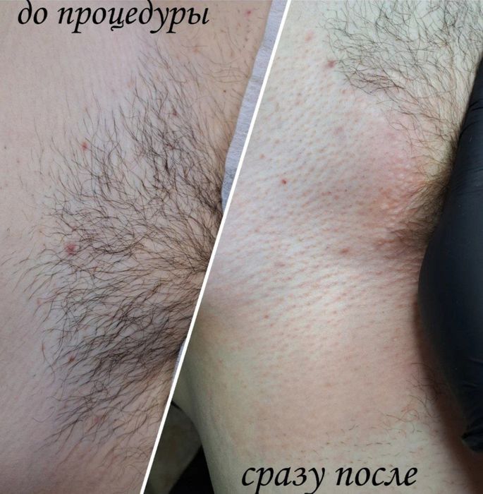 Депиляция епилатция косметология  еркаклар ун