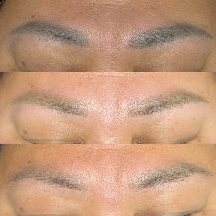 Лазерное удаление татуажа