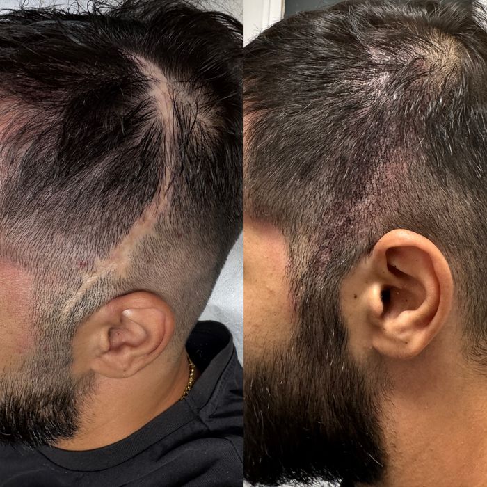 Micropigmentare Scalp și barba Bucuresti SMP chelie implant transplant