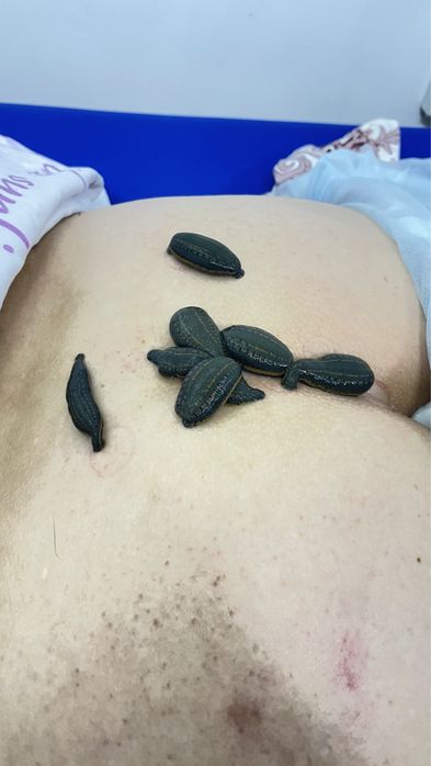 Лечение пиявками, сүлікпен емдеу