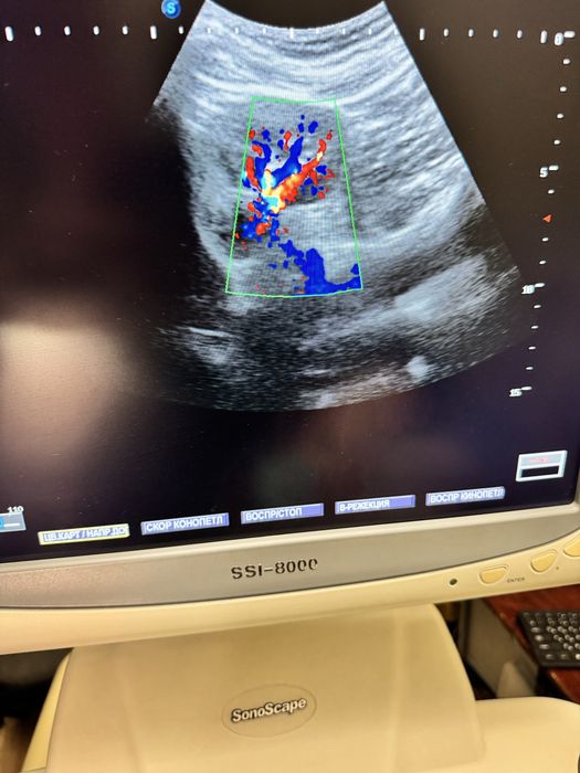Узи аппарат SonoScape SSI 8000