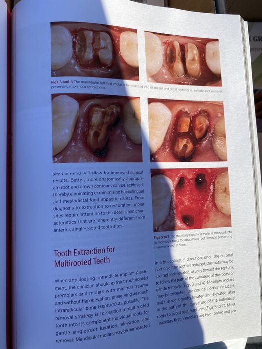 The Single-Tooth Implant J.Chu