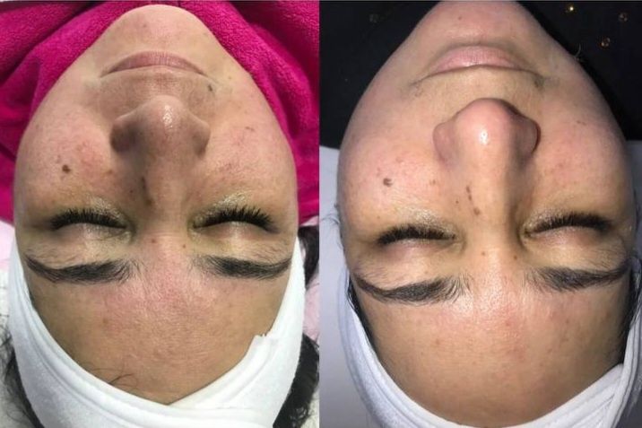 Косметолог для женщин чистка лица пиллинг возможно выезд м. Шахристон