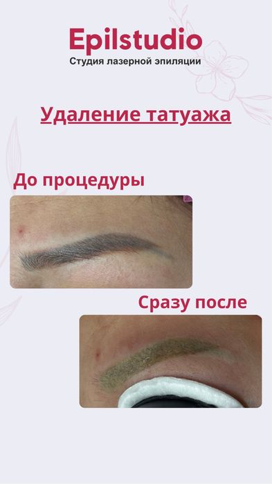 Удаление татуажа