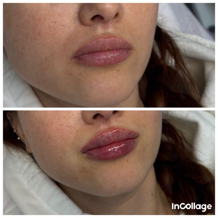 Увеличение губ