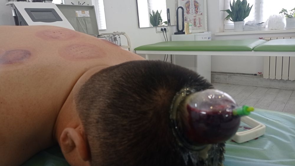 хиджама, массаж, диагностика, иглотерапия