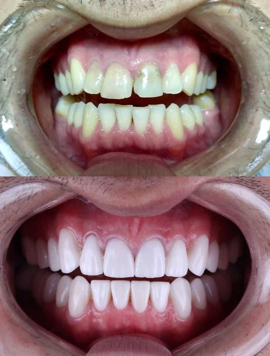 CAD/CAM Цифровая Зуботехническая Лаборатория Стоматолог Цирконий Зубы