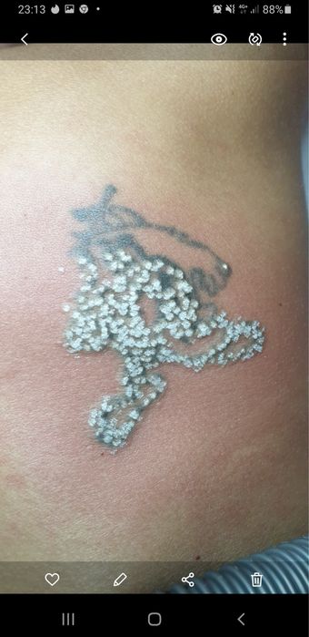 Laser scoatere tatuaj corporal si facial