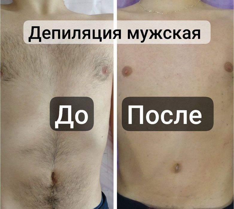 Депиляция епилатсия еркалар ва аёлар ун