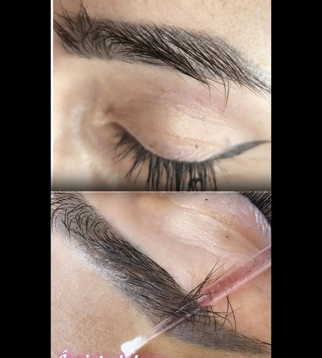 Îndepărtare tatuaj sprâncene și corp | Laser | PMU/Microblading