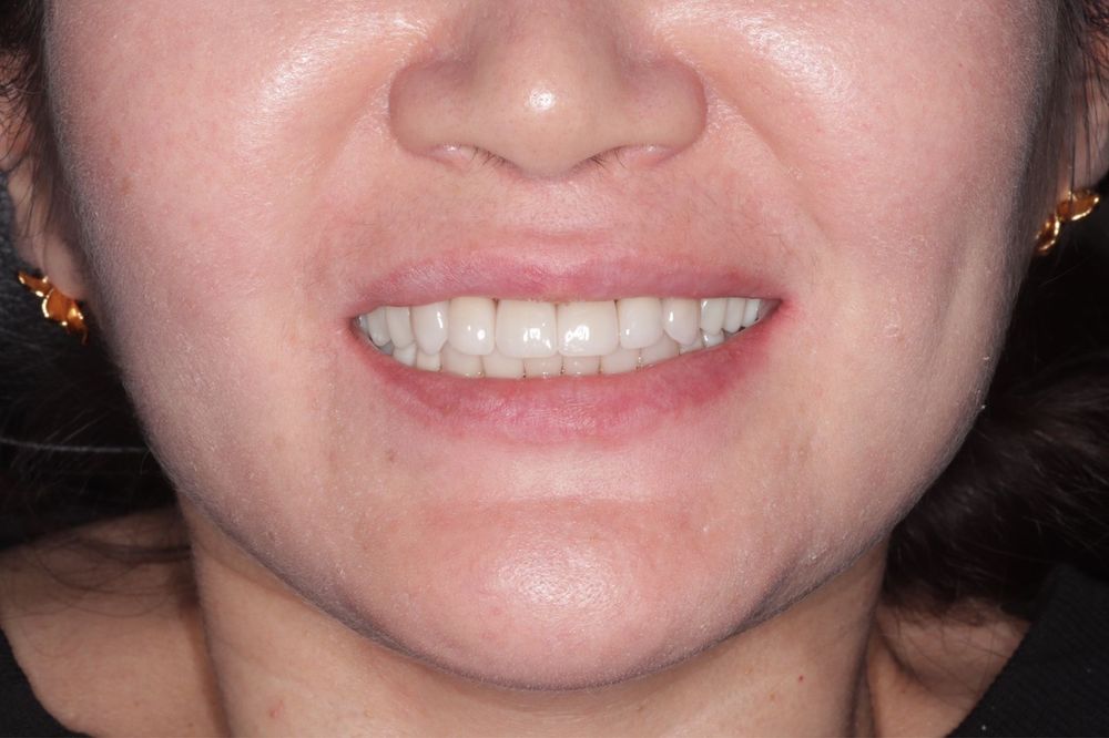 Импланты от 49.999.