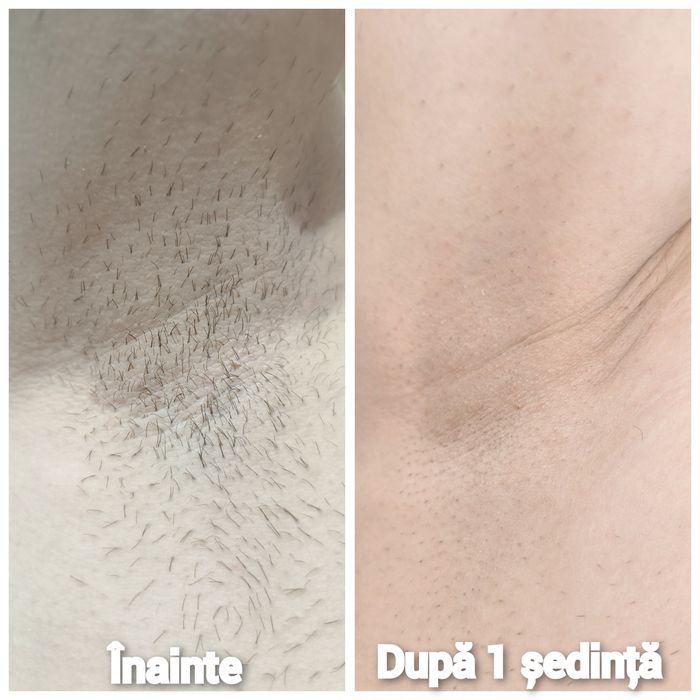 Epilare definitiva cu 4 lungimi de undă, cu ceara și tratamente