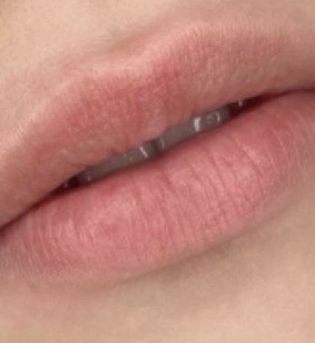 Акция Увелечение губ