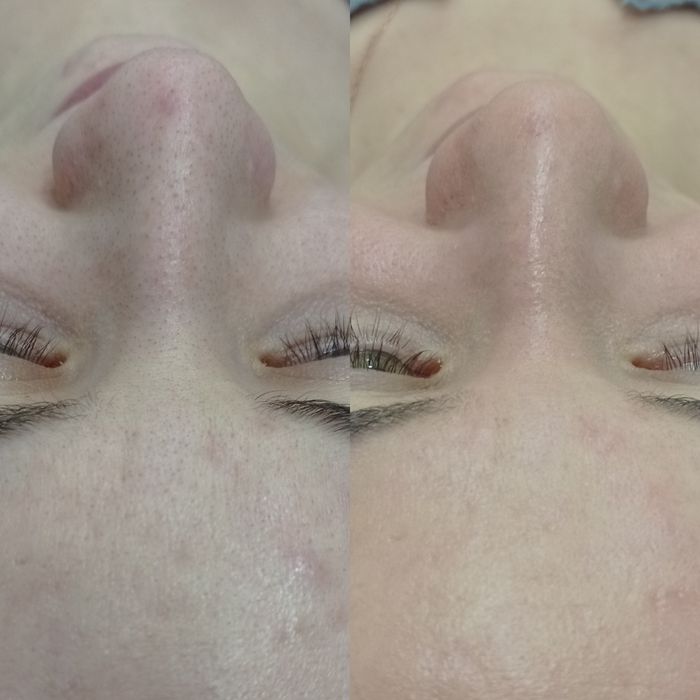 Врач косметолог. Ташкент. Атравматичная, комплексная чистка лица