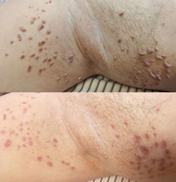 Удаление папиллом и бородавок