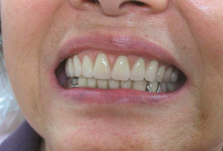 Зубные съёмные протезы