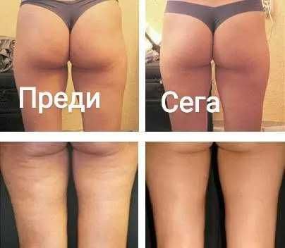 Антицелулитни процедури