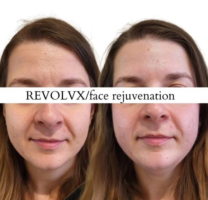 Aparat profesional de remodelare corporala și facială REVOLV-X