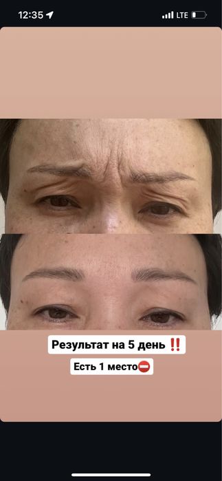 Плазмолифтинг - 7990