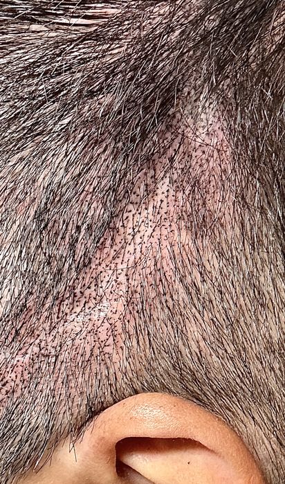 Curs SMP micropigmentare scalp fizic sau online