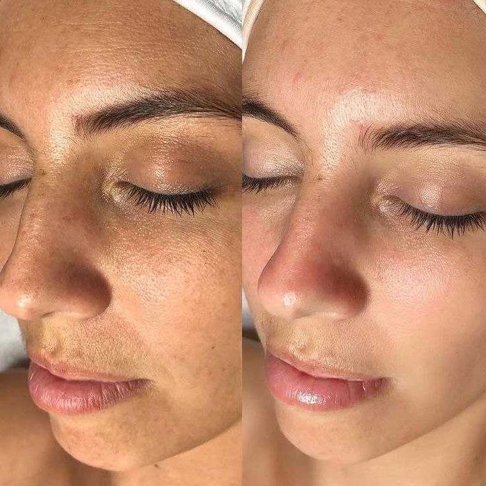 Kosmetologiya | Yuzni tozalash, parvarish, pilinglar