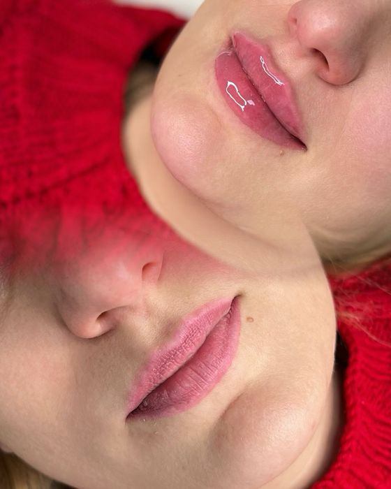 Филлер, увеличение губ со скидкой