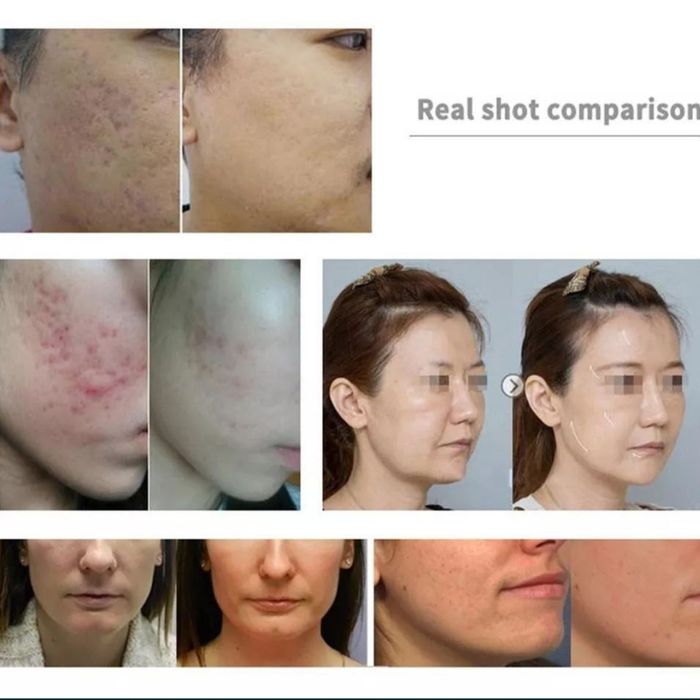 Всетодиодная LED маска для лица творит настоящие чудеса с кожей лица.