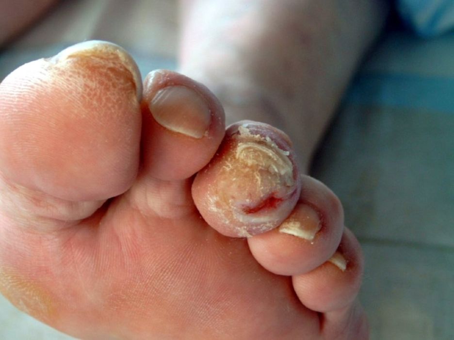 Квалифицированная помощь подолога.