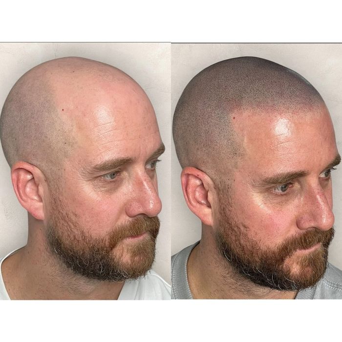 Micropigmentare scalp barba efect indesire par
