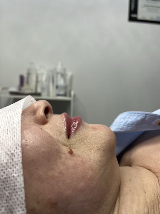 Аугментация губ,Чистка лица,БРВ,Мезотерапия