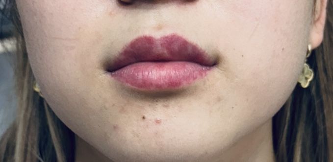 Эстетические процедуры для лица и губ.