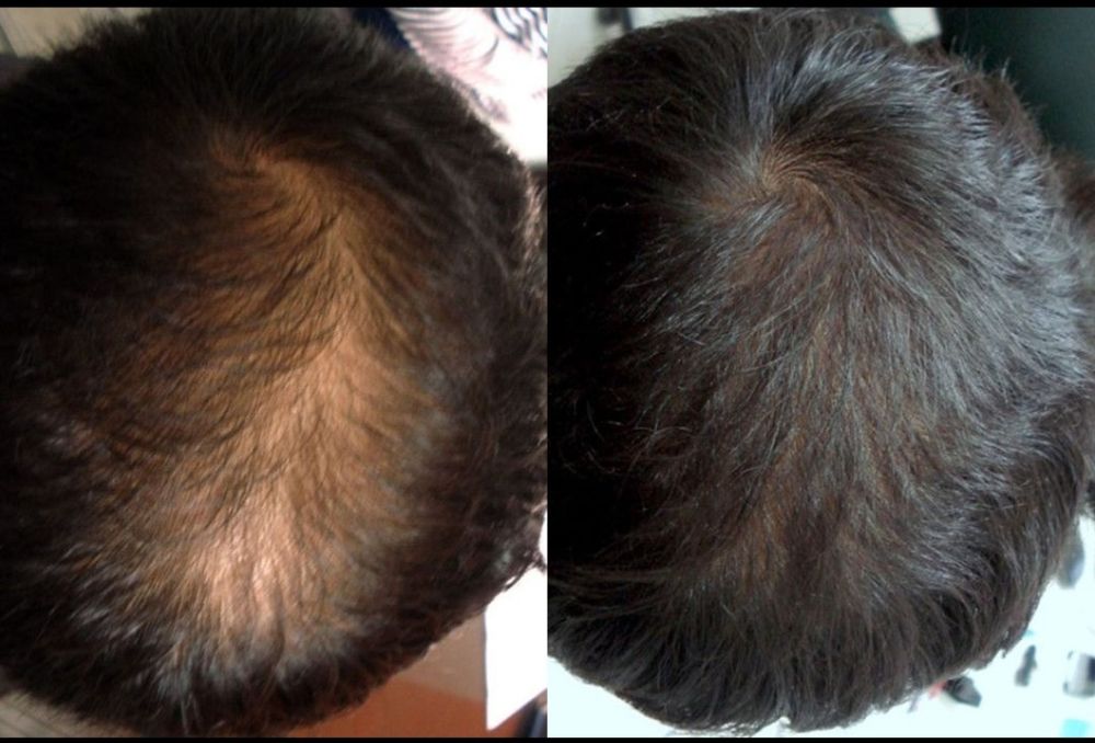 Трихопигментация волос