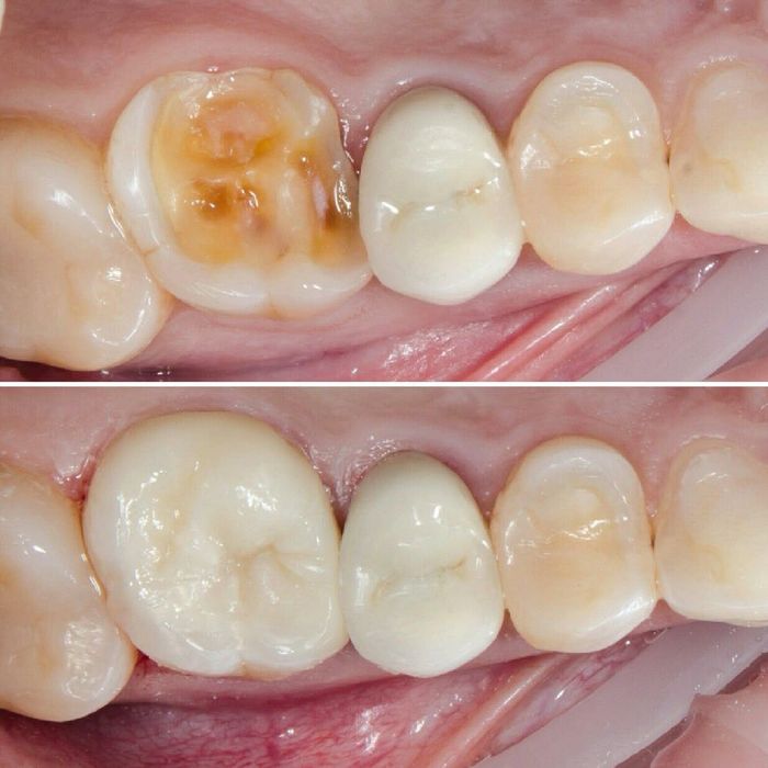 Лечение кариеса без боли!