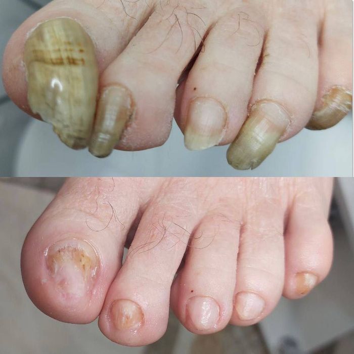 Лечение и исправление вросших ногтей.  Падолог