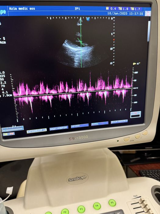 Узи аппарат SonoScape SSI 8000