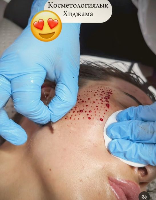 Хиджама, лечение пиявками массаж