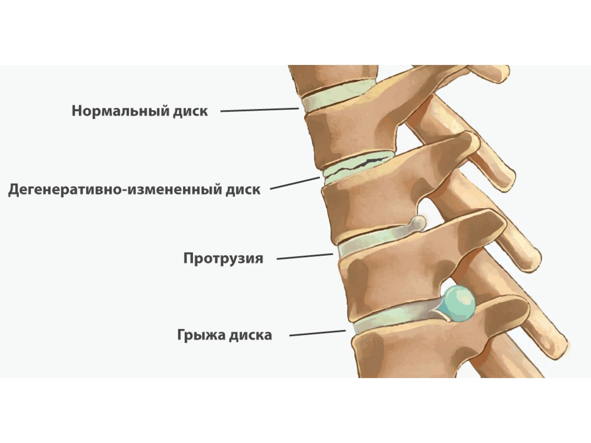 Протрузия что это. Протрузии межпозвоночного диска. Протрузии позвонков поясничного отдела. Позвоночник диск l5-s1 грыжа. Межпозвоночные диски l1-s1.