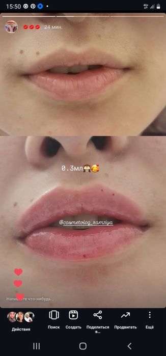 Губки , филлер, ботокс . Качественно!