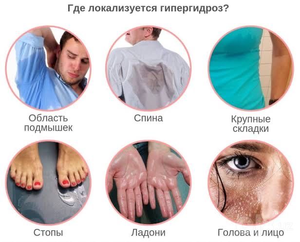 Гипергидроз | потливость |дискомфорт ? Решение есть  запись