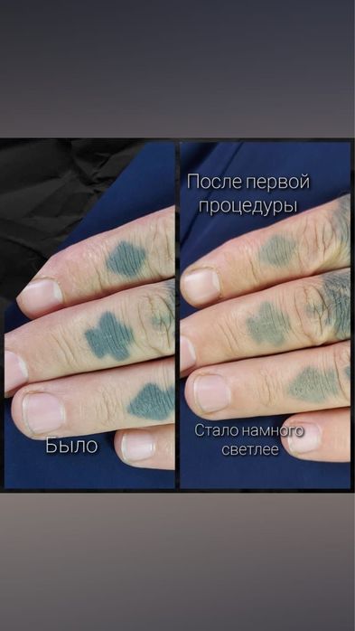 Продам лазер для удаления тату