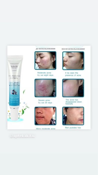 Шифейши крем от угрей