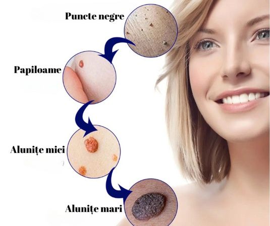 Crema pentru eliminarea papiloamelor