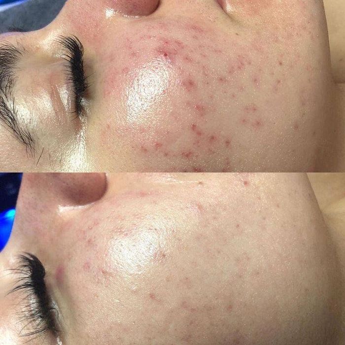 Естественное омоложение холодной плазмой