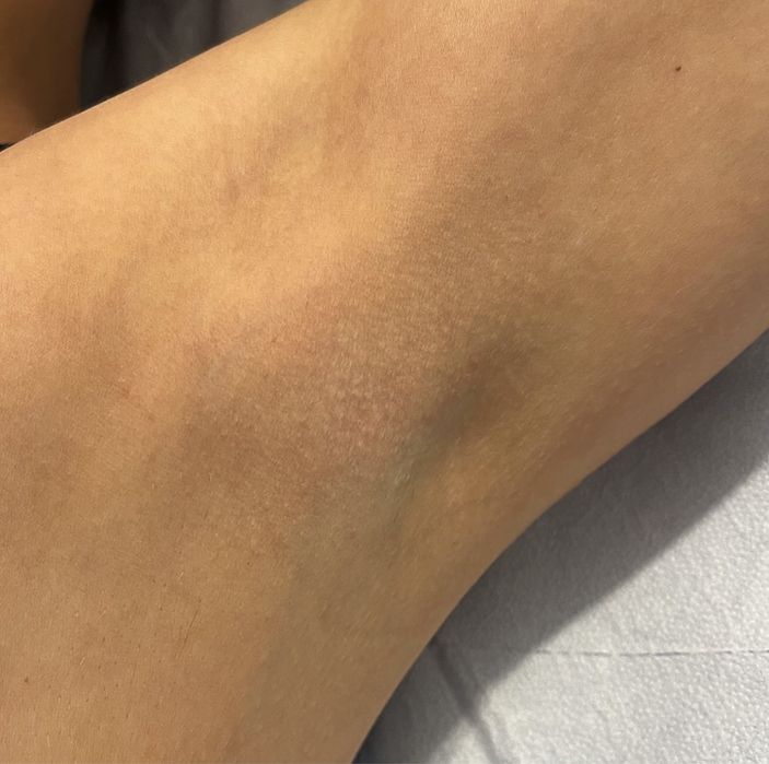 Epilare definitiva laser Bucuresti Sector 3 (zona trapezului)