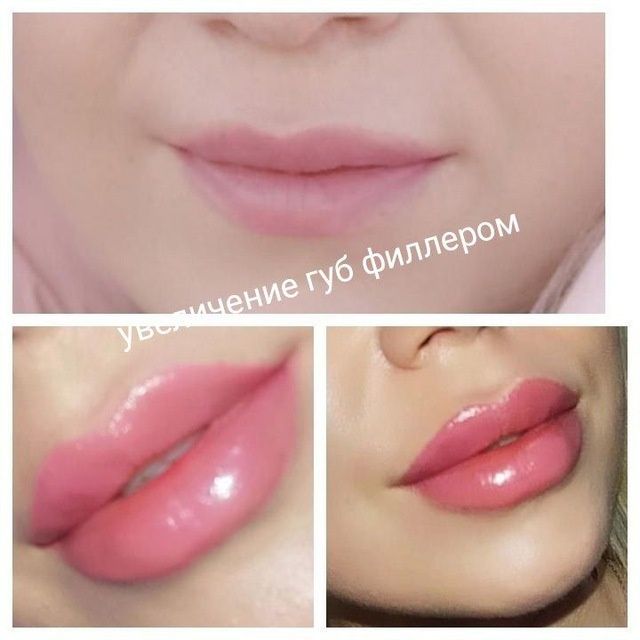 Увеличение губ филлером