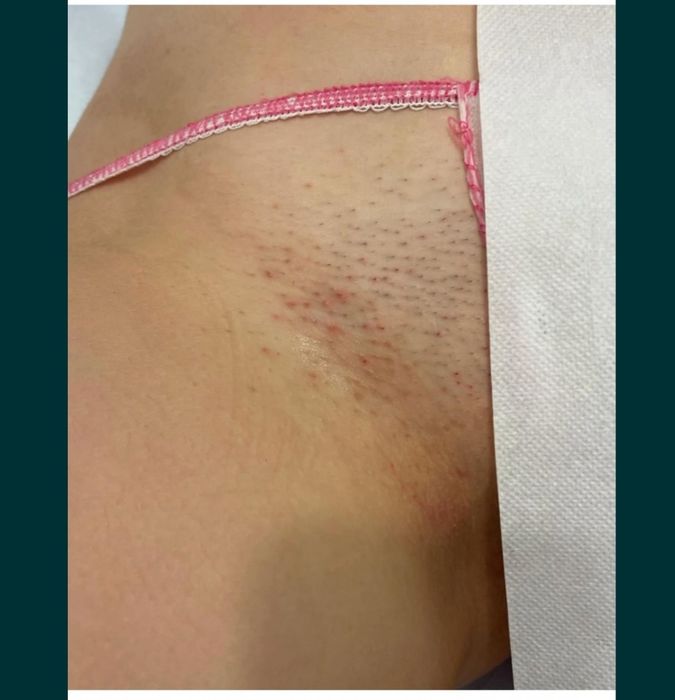 Epilare definitiva Sector 2