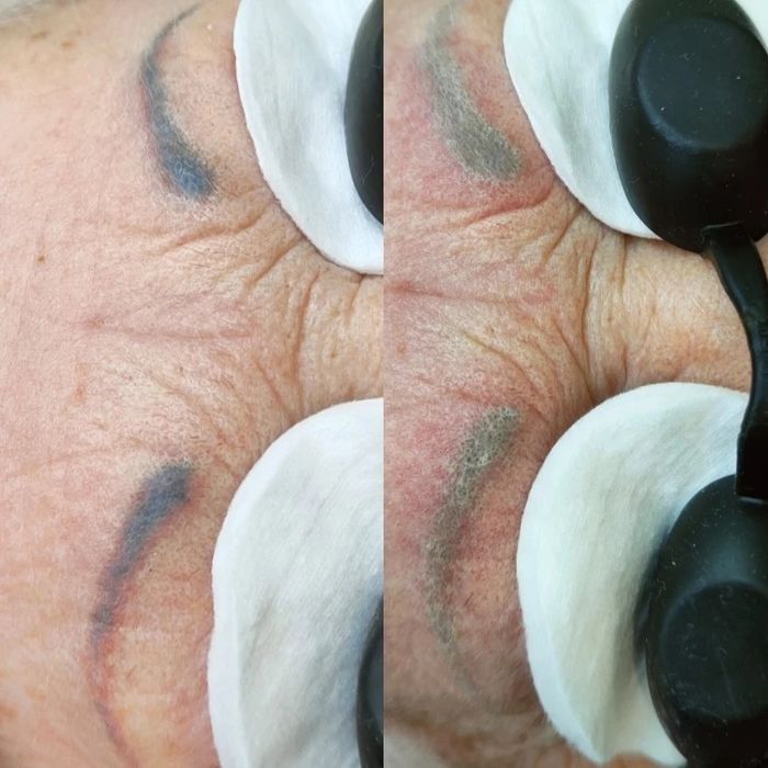 Удаление татуажа, тату