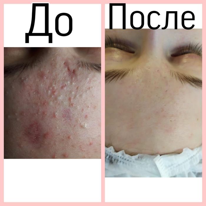 Косметолог, Чистка лица .