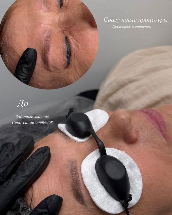 Лазерное удаление татуажа 5000