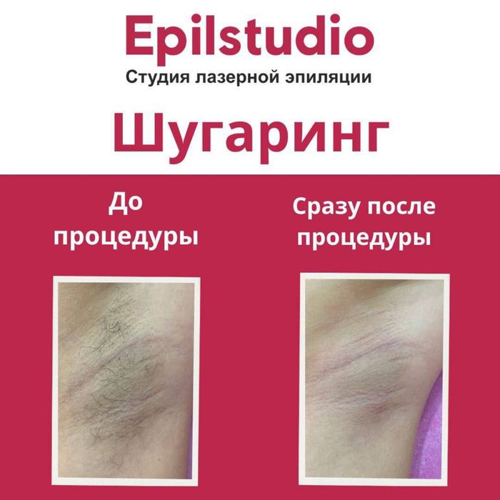 Удаление волос шугаринг